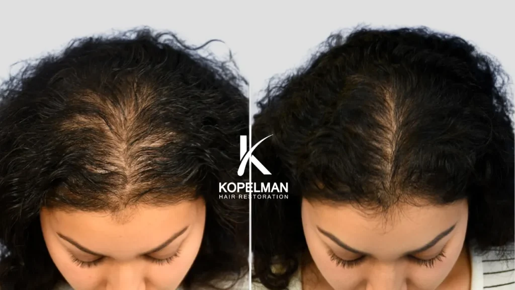 The current image has no alternative text. The file name is: Mesotherapy-Before-and-After-_-female-Hair-Loss-treatment-2.webp