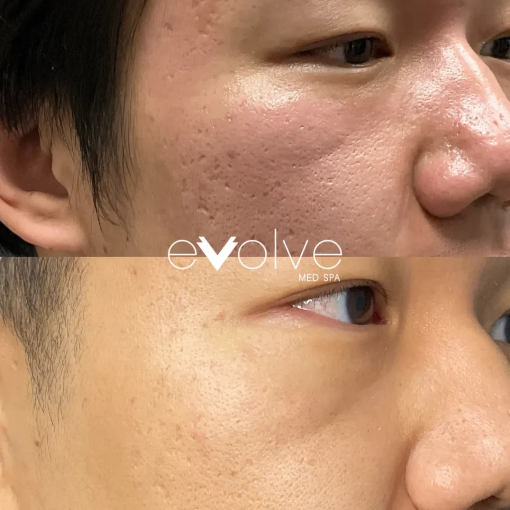 The current image has no alternative text. The file name is: prp-skin-rejuvenation-4.webp